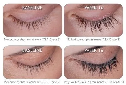 Latisse before & after Spring treatment